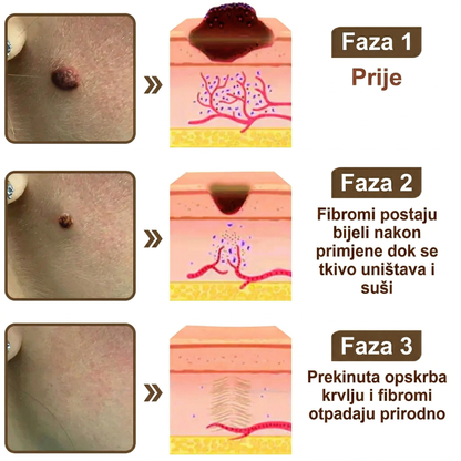 FIVFIVGO® Umirujuća krema za obnovu s crnom i bijelom rižom👨‍⚕️Odobrena od strane HALMED (Uklanjanje bradavica i kožnih izraslina, senilne purpure, angioma trešnje, raka kože i seboroične keratoze.👨‍⚕️