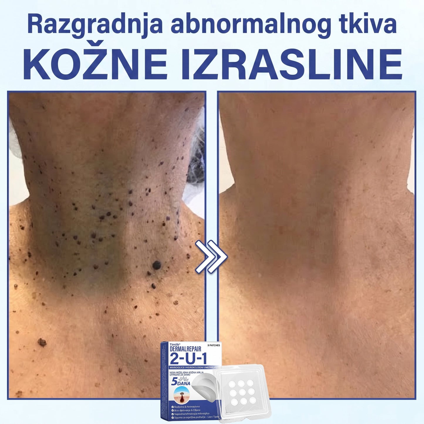 🔥Timilk® Dermalna Obnova 2-U-1 Mikroiglice & Hidrokoloidni flaster 💉| Sredstvo za uklanjanje podignutih madeža, akni, ravnih bradavica i kožnih izraslina | Ublažava bore, ožiljke i mrlje | Nevidljivi flasteri za prištiće za lice i tijelo💎