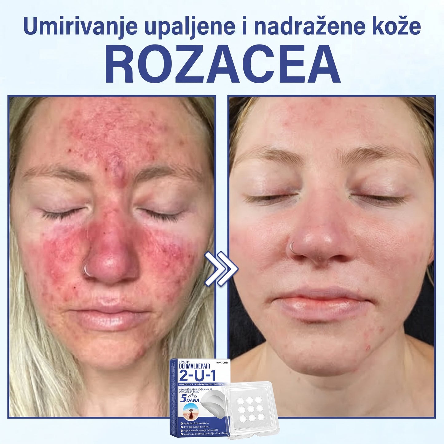 🔥Timilk® Dermalna Obnova 2-U-1 Mikroiglice & Hidrokoloidni flaster 💉| Sredstvo za uklanjanje podignutih madeža, akni, ravnih bradavica i kožnih izraslina | Ublažava bore, ožiljke i mrlje | Nevidljivi flasteri za prištiće za lice i tijelo💎
