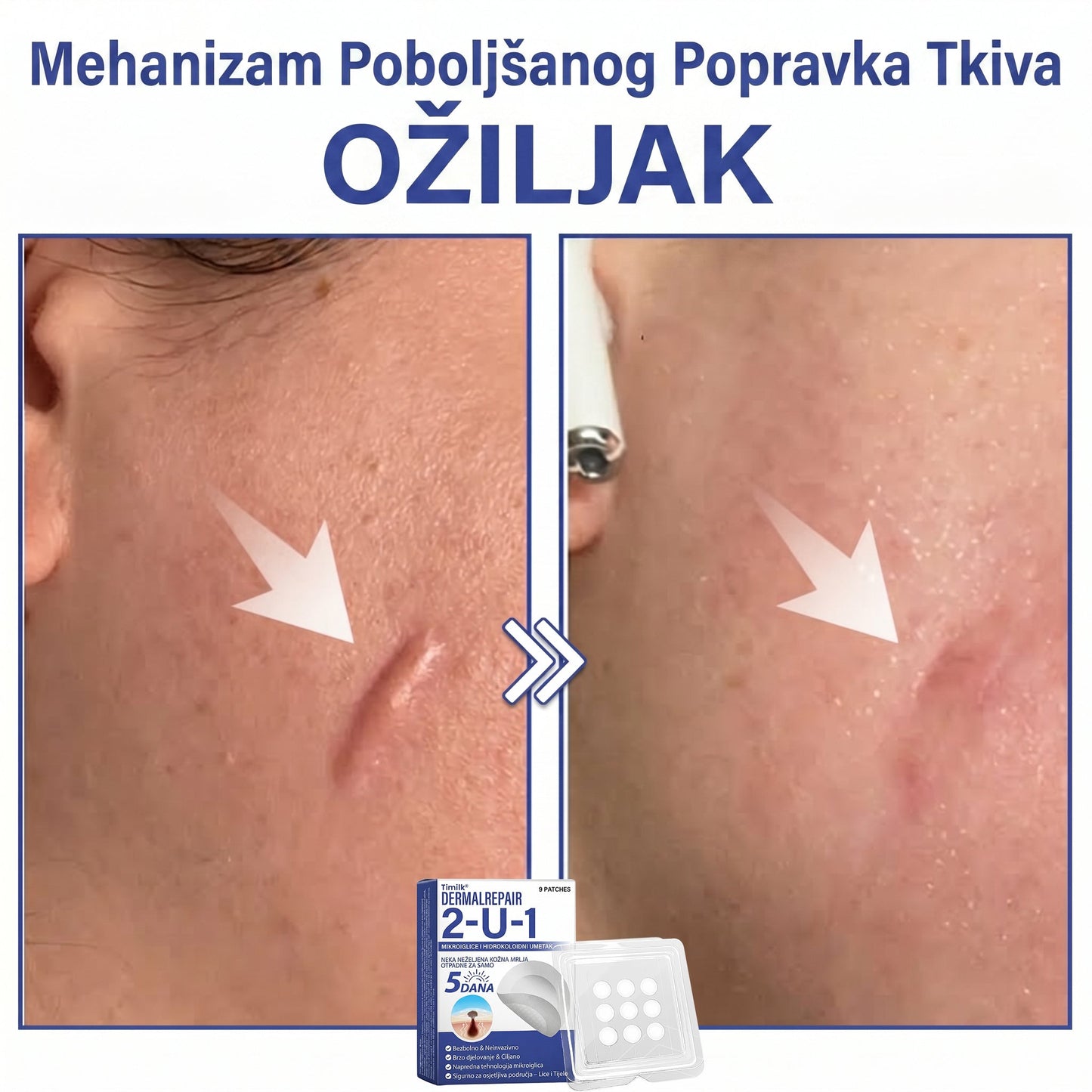 🔥Timilk® Dermalna Obnova 2-U-1 Mikroiglice & Hidrokoloidni flaster 💉| Sredstvo za uklanjanje podignutih madeža, akni, ravnih bradavica i kožnih izraslina | Ublažava bore, ožiljke i mrlje | Nevidljivi flasteri za prištiće za lice i tijelo💎