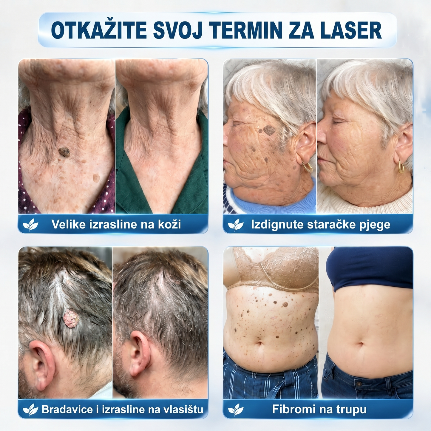 𝐏i𝐜𝐝o® 𝟕-𝐝𝐧𝐞𝐯𝐧𝐢 𝐨𝐝𝐬𝐭𝐫𝐚𝐧𝐣𝐢𝐯𝐚č 𝐛𝐫𝐚𝐝𝐚𝐯𝐢𝐜𝐚 𝐢 𝐦𝐫𝐥𝐢𝐚(Rollerball bez boli, bez ožiljaka)💪