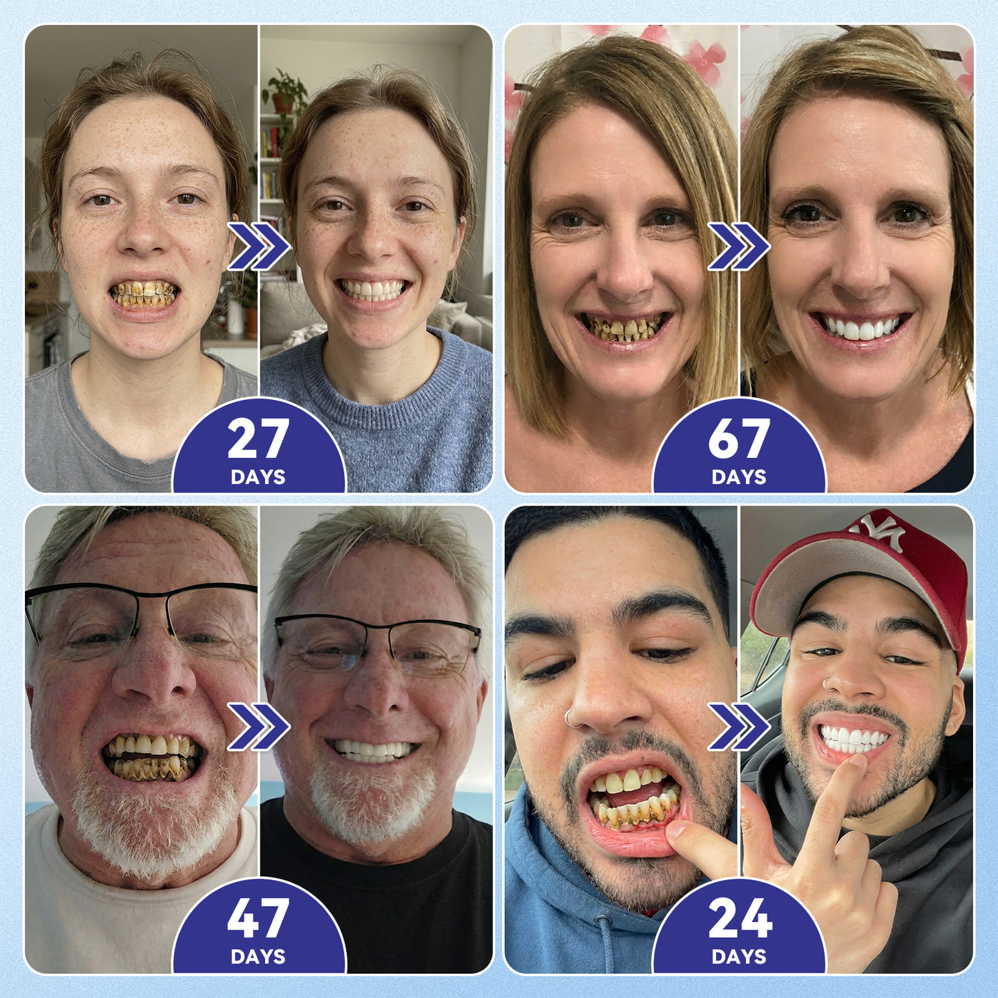 🦷𝐆𝐥𝐢𝐦𝐦𝐞𝐫𝐥𝐲® Tideglusib flaster s mikroiglama za popravak zubi i desni|Napredne trakice za aktivaciju matičnih stanica (obnavljaju caklinu i dentin, jačaju desni, uklanjaju kamenac i neugodne mirise, zaustavljaju osjetljivost zuba)) 3.0
