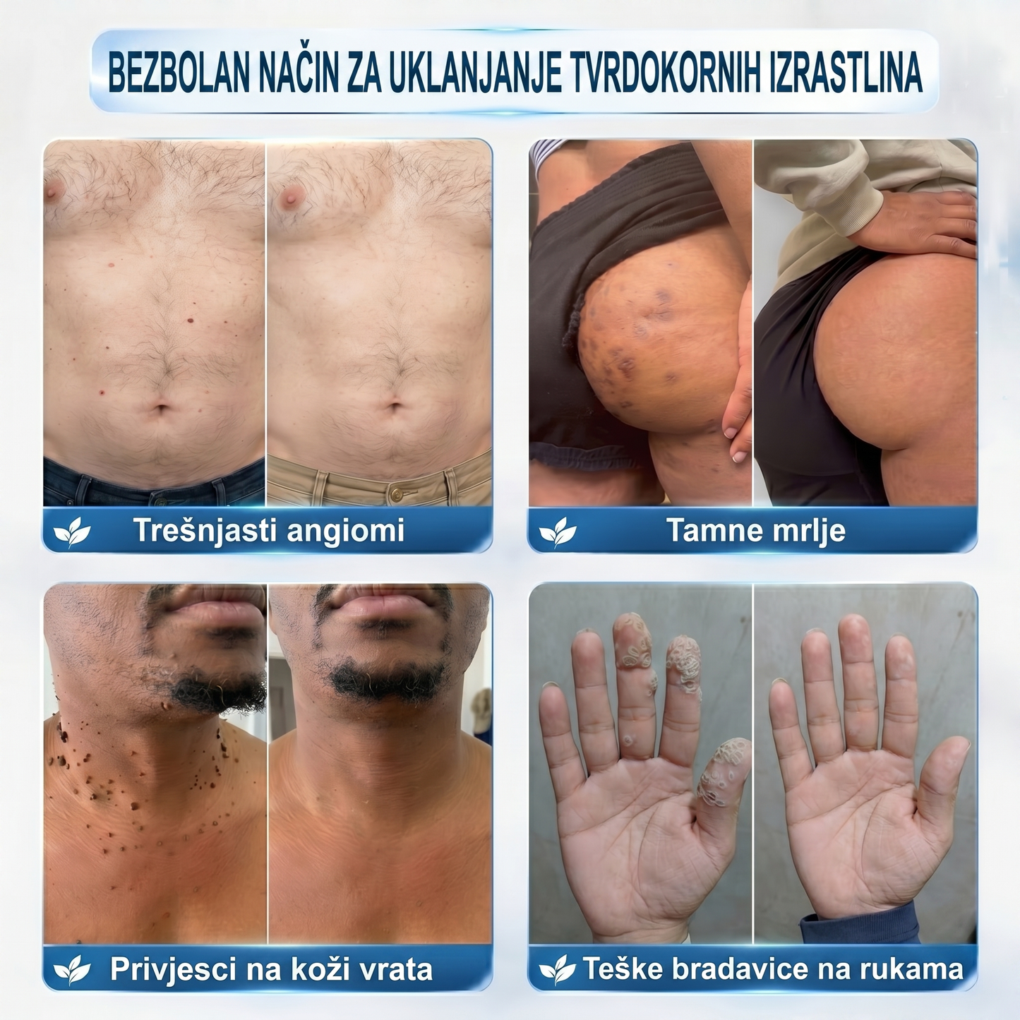 𝐏i𝐜𝐝o® 𝟕-𝐝𝐧𝐞𝐯𝐧𝐢 𝐨𝐝𝐬𝐭𝐫𝐚𝐧𝐣𝐢𝐯𝐚č 𝐛𝐫𝐚𝐝𝐚𝐯𝐢𝐜𝐚 𝐢 𝐦𝐫𝐥𝐢𝐚(Rollerball bez boli, bez ožiljaka)💪