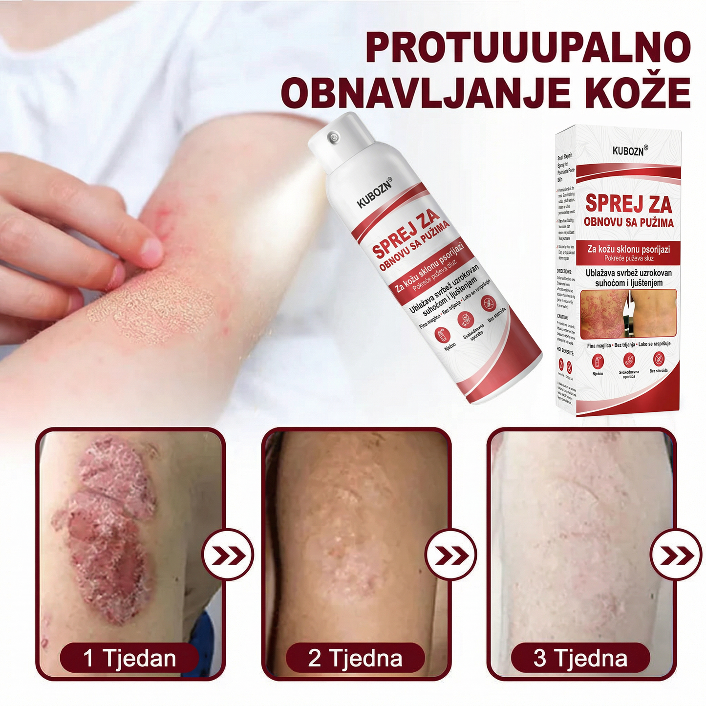 KUBOZN® SPREJ ZA OBNOVU SA PUZIMA za svrbežnu, perutavu kožu kod psorijaze